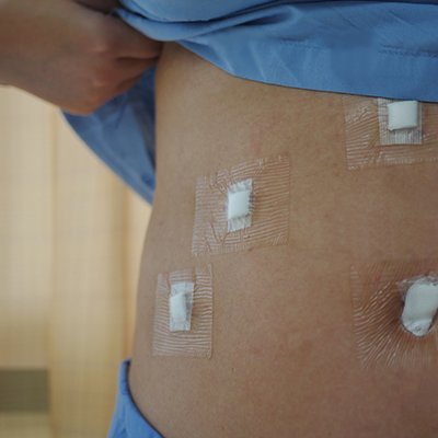 A woman lifts her shirt to show dressings from keyhole surgery on her abdomen.